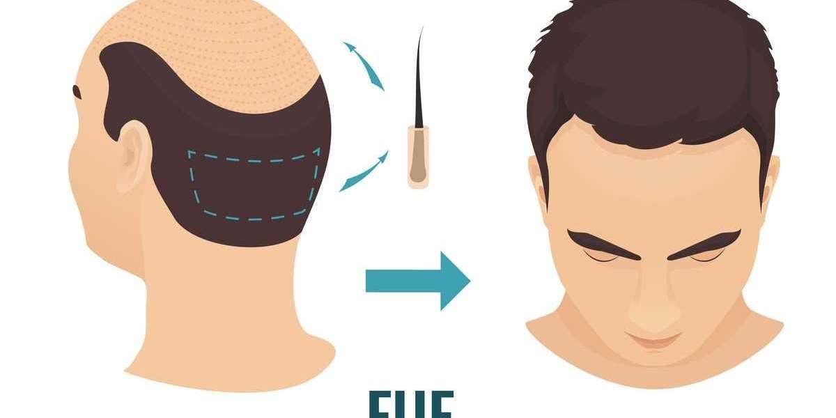 Hair transplant fue cost